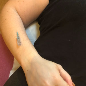 Patient with FSN needle in arm